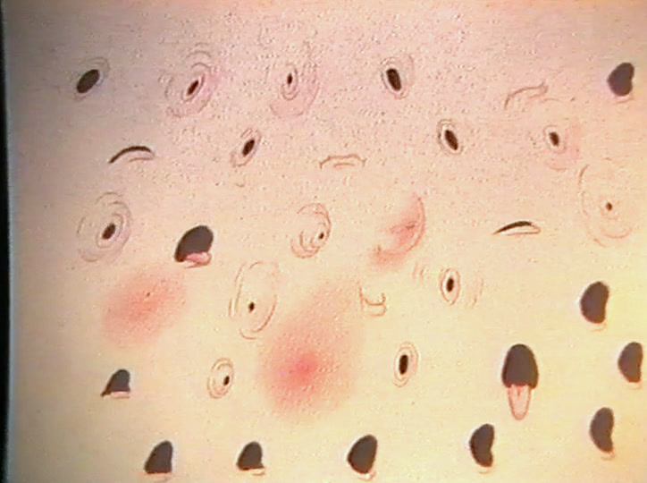 Magnified skin with dark pores and several red inflamed spots between them.